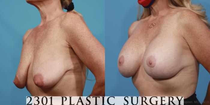 Before & After Mastopexy & Augmentation Case 642 Left Oblique View in Fort Worth, Plano, & Frisco, Texas