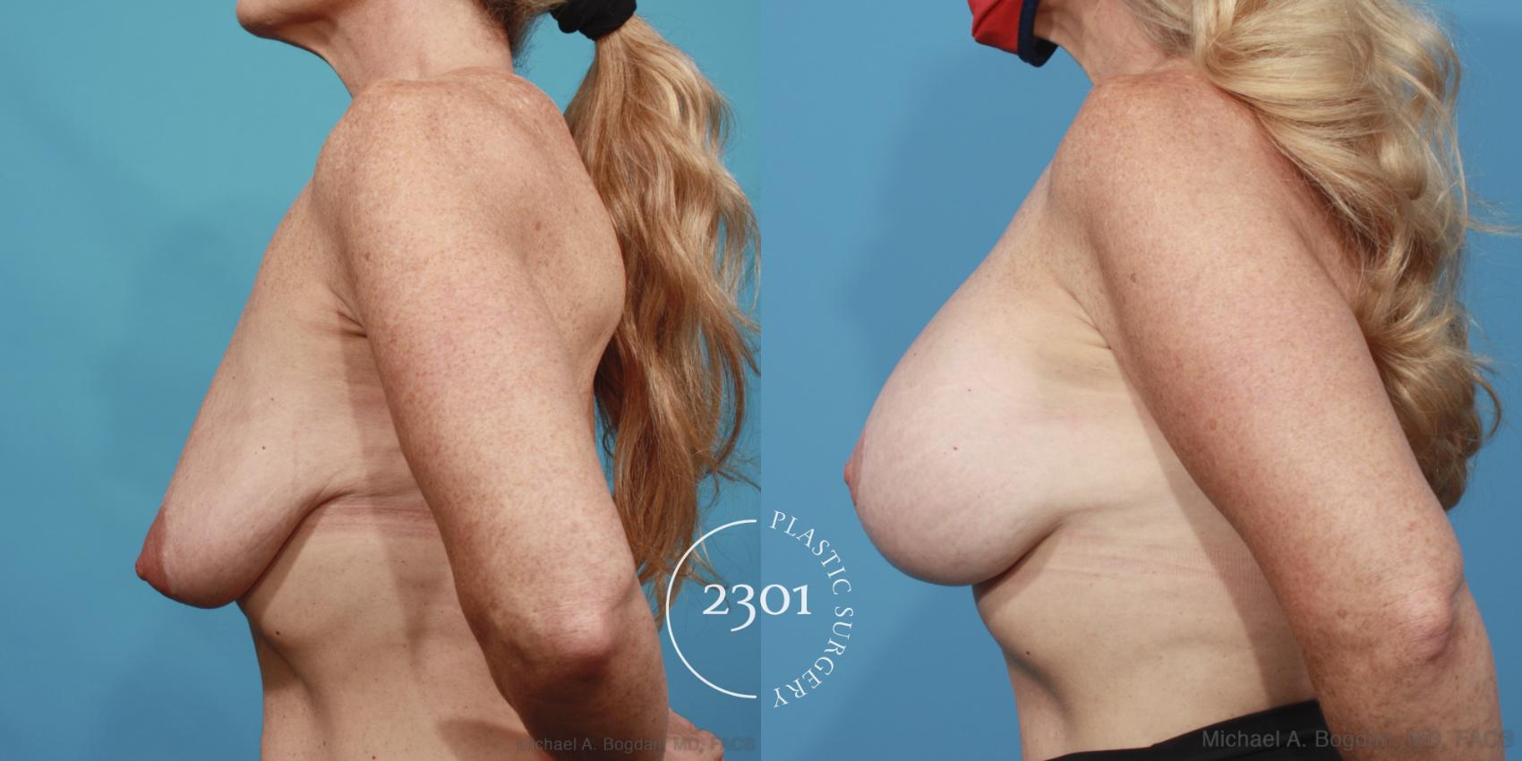Before & After Silicone Implants Case 642 Left Side View in Fort Worth, Plano, & Frisco, Texas
