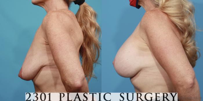 Before & After Breast Lift (Mastopexy) Case 642 Left Side View in Fort Worth, Plano, & Frisco, Texas