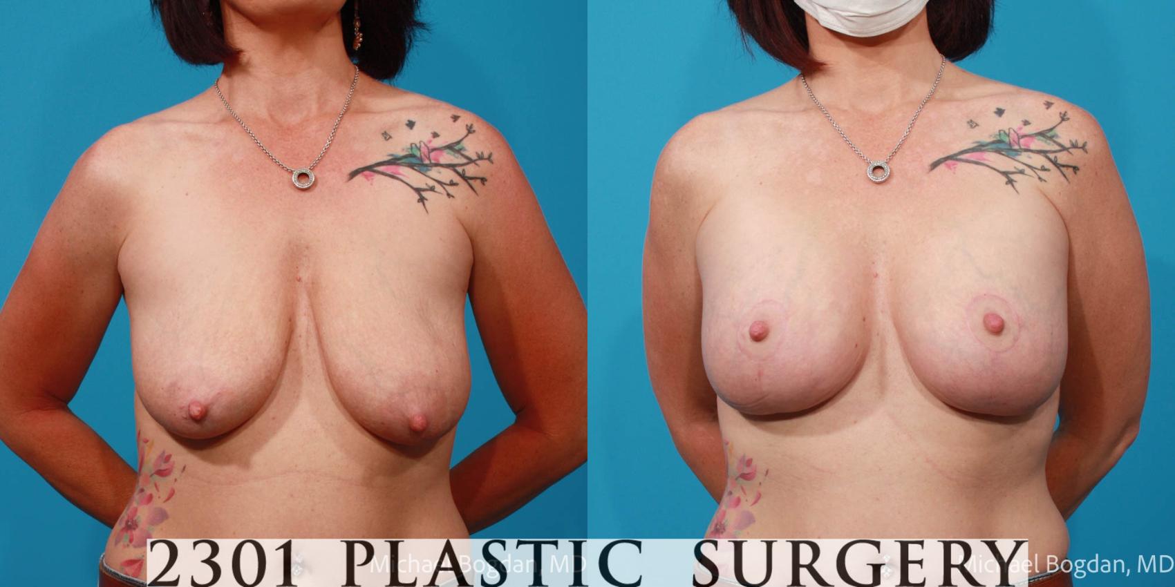 Before & After Mastopexy & Augmentation Case 677 Front View in Fort Worth & Frisco, Texas