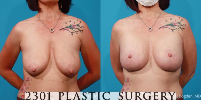 Before & After Mastopexy & Augmentation Case 677 Front View in Fort Worth, Plano, & Frisco, Texas