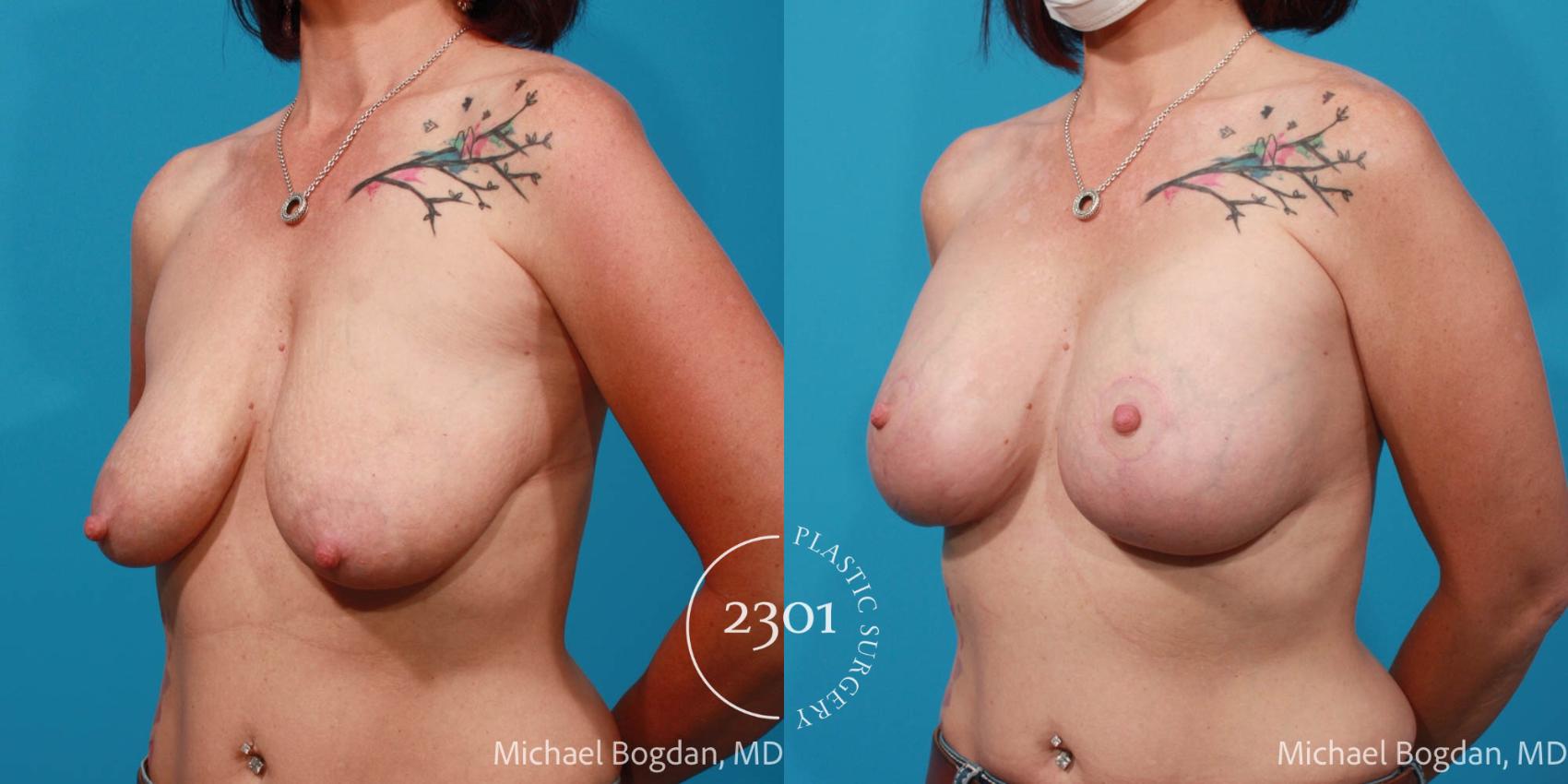 Before & After Silicone Implants Case 677 Left Oblique View in Fort Worth, Plano, & Frisco, Texas