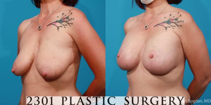 Before & After Mastopexy & Augmentation Case 677 Left Oblique View in Fort Worth, Plano, & Frisco, Texas