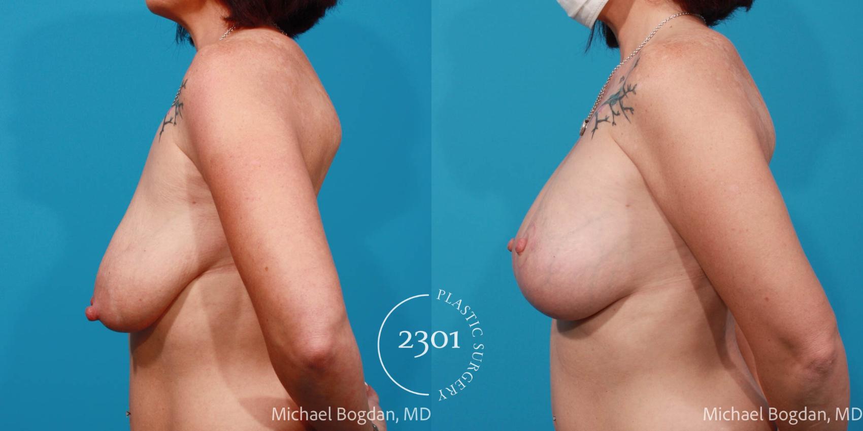 Before & After Silicone Implants Case 677 Left Side View in Fort Worth, Plano, & Frisco, Texas