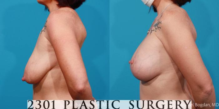 Before & After Mastopexy & Augmentation Case 677 Left Side View in Fort Worth, Plano, & Frisco, Texas