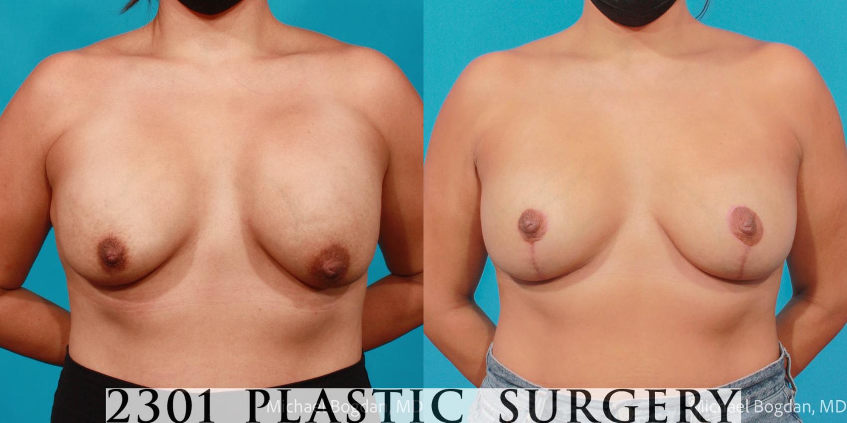 Before & After Mastopexy & Augmentation Case 703 Front View in Fort Worth & Frisco, Texas