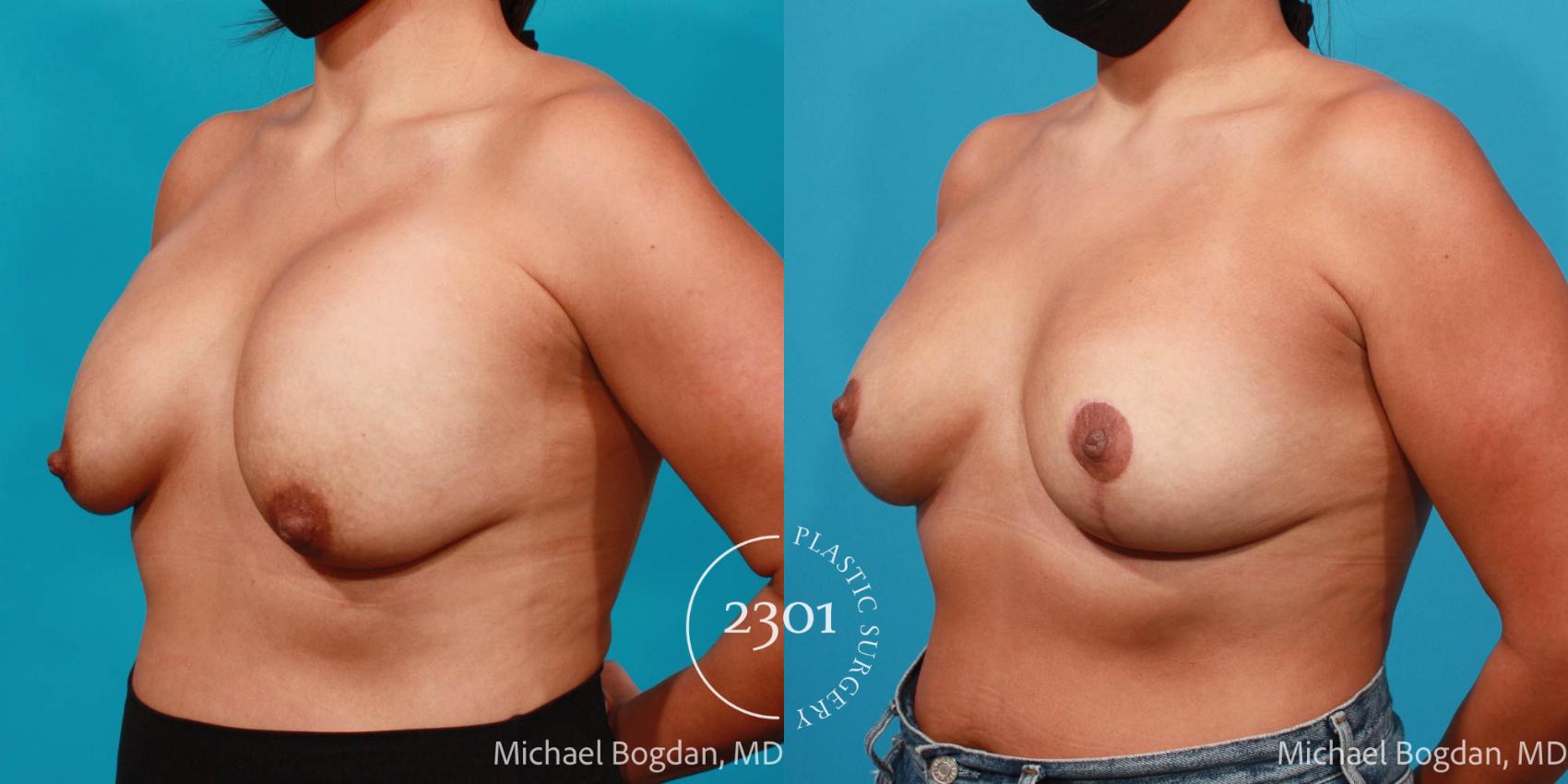 Before & After Mastopexy & Augmentation Case 703 Left Oblique View in Fort Worth, Plano, & Frisco, Texas