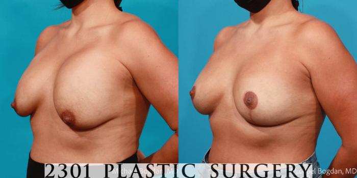 Before & After Mastopexy & Augmentation Case 703 Left Oblique View in Fort Worth, Plano, & Frisco, Texas