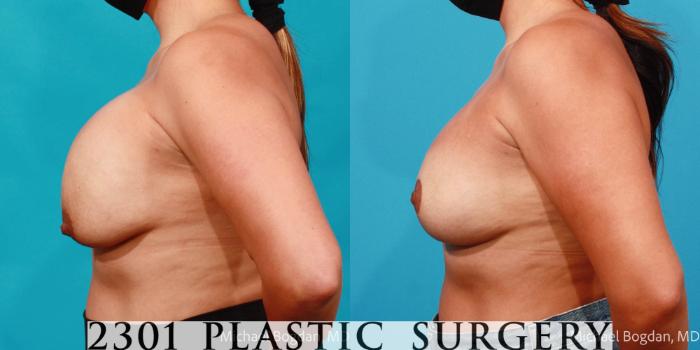 Before & After Breast Augmentation Revision Case 703 Left Side View in Fort Worth, Plano, & Frisco, Texas