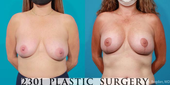 Before & After Silicone Implants Case 710 Front View in Fort Worth, Plano, & Frisco, Texas