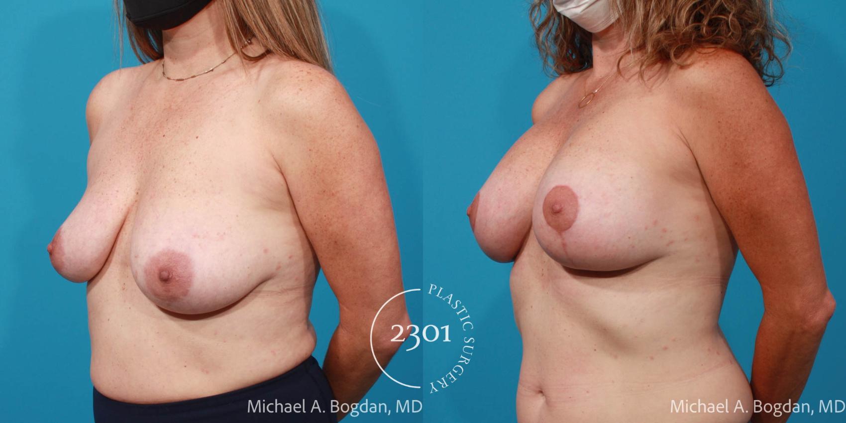 Before & After Silicone Implants Case 710 Left Oblique View in Fort Worth, Plano, & Frisco, Texas