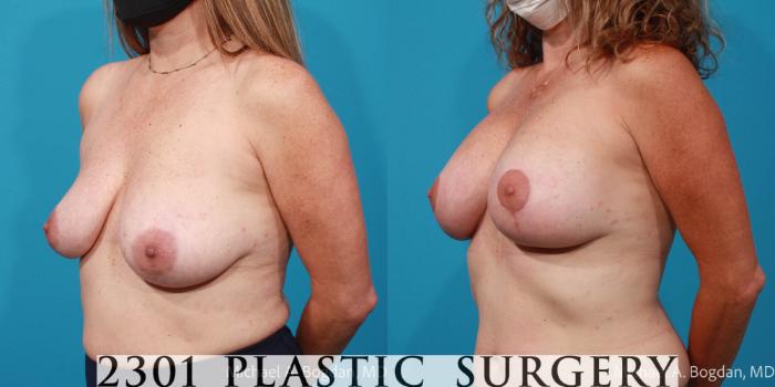 Before & After Mastopexy & Augmentation Case 710 Left Oblique View in Fort Worth, Plano, & Frisco, Texas