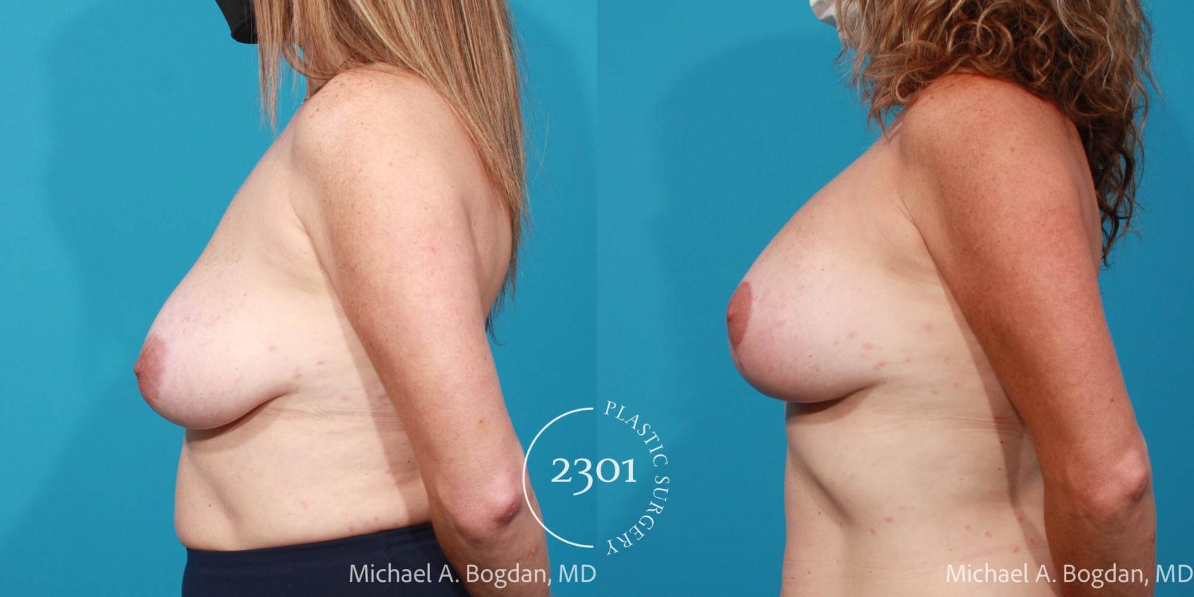 Before & After Silicone Implants Case 710 Left Side View in Fort Worth, Plano, & Frisco, Texas