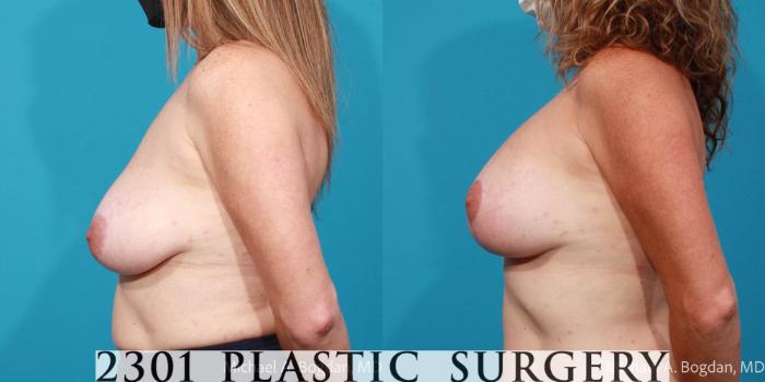 Before & After Mastopexy & Augmentation Case 710 Left Side View in Fort Worth, Plano, & Frisco, Texas