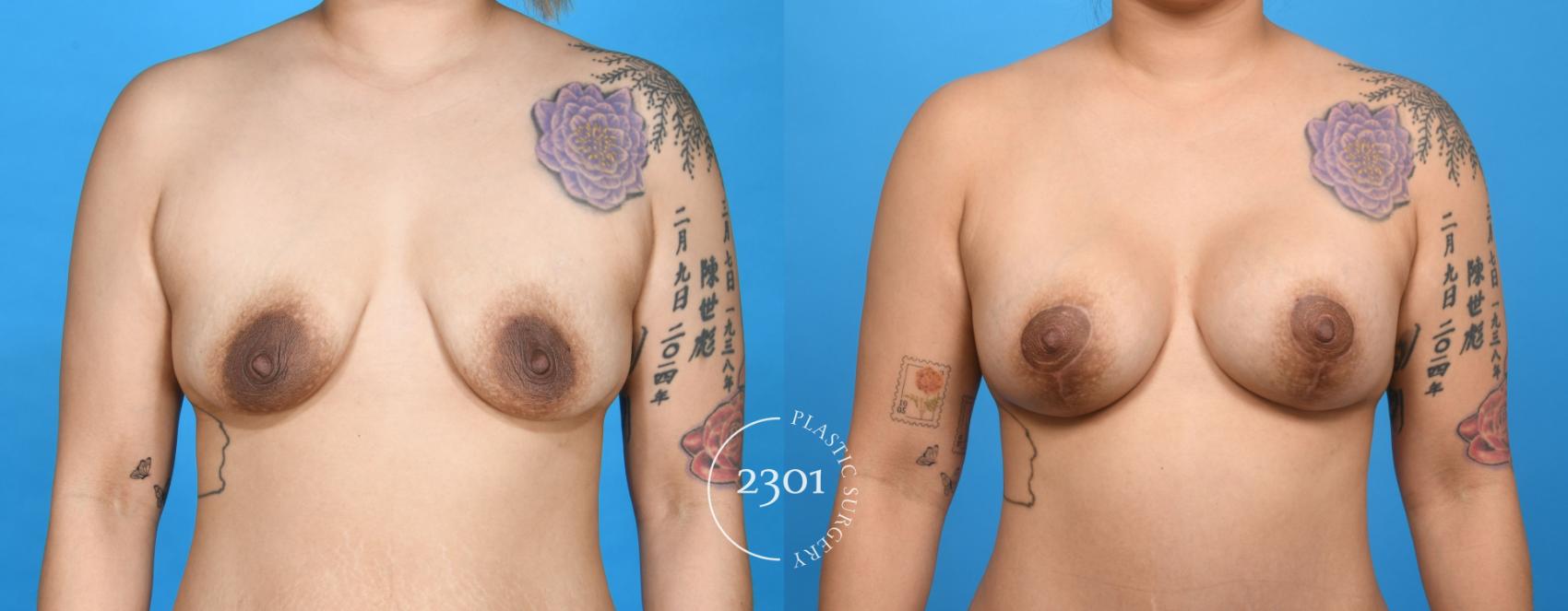 Before & After Mastopexy & Augmentation Case 735 Front View in Fort Worth, Plano, & Frisco, Texas