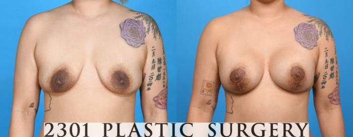 Before & After Mastopexy & Augmentation Case 735 Front View in Fort Worth & Frisco, Texas