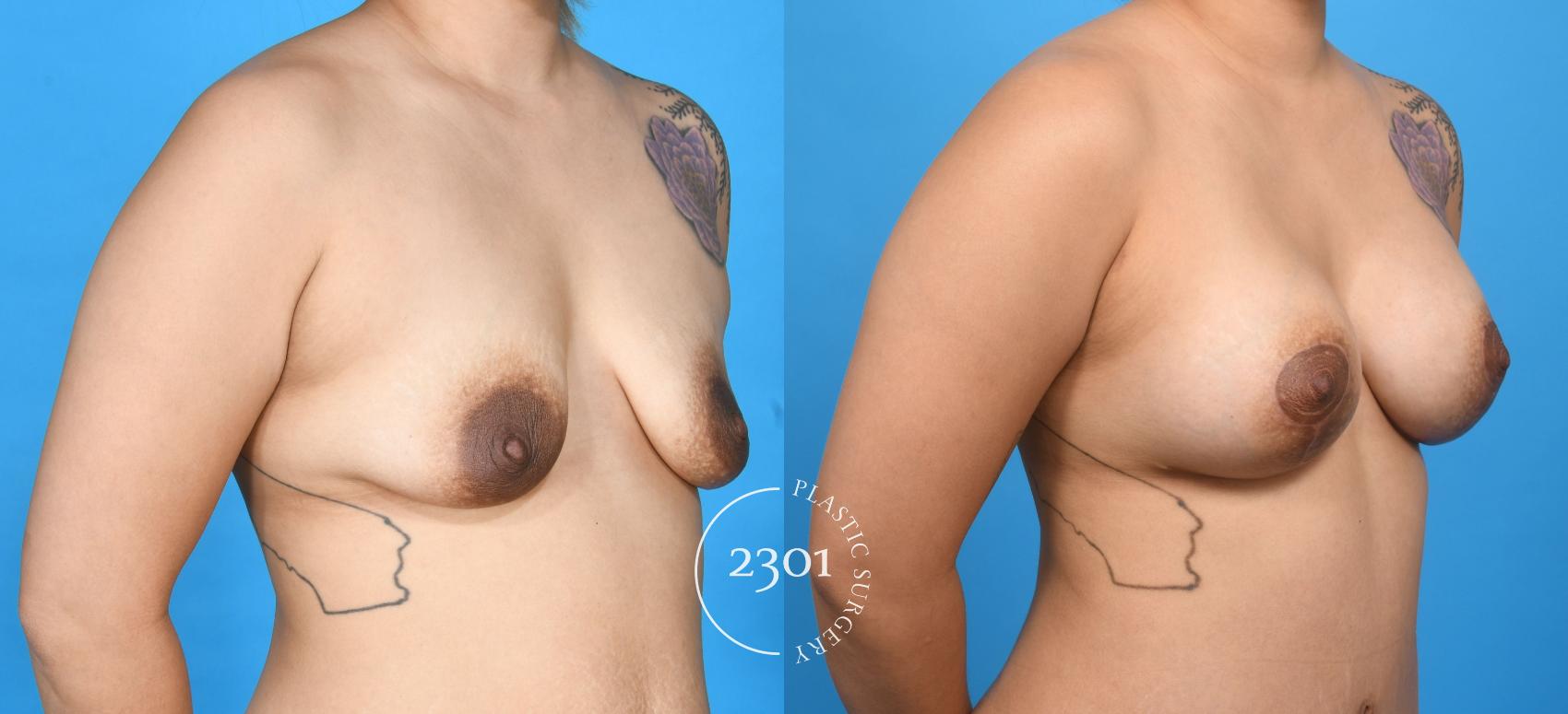 Before & After Breast Lift (Mastopexy) Case 735 Right Oblique View in Fort Worth, Plano, & Frisco, Texas