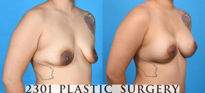 Before & After Silicone Implants Case 735 Right Oblique View in Fort Worth, Plano, & Frisco, Texas