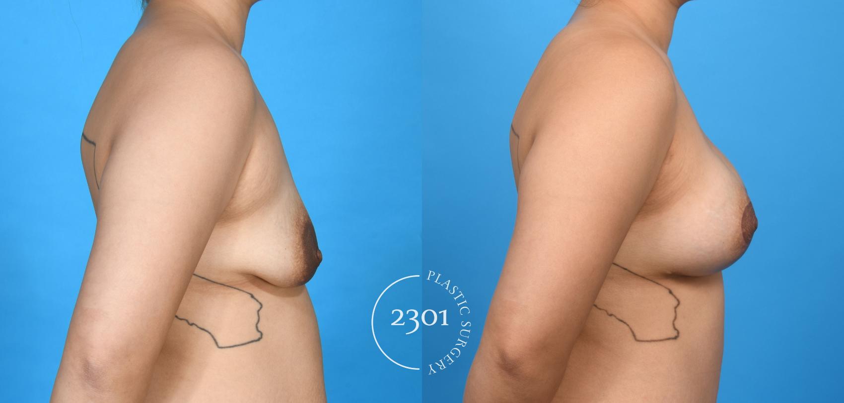 Before & After Mastopexy & Augmentation Case 735 Right Side View in Fort Worth, Plano, & Frisco, Texas