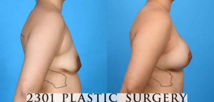 Before & After Mastopexy & Augmentation Case 735 Right Side View in Fort Worth, Plano, & Frisco, Texas