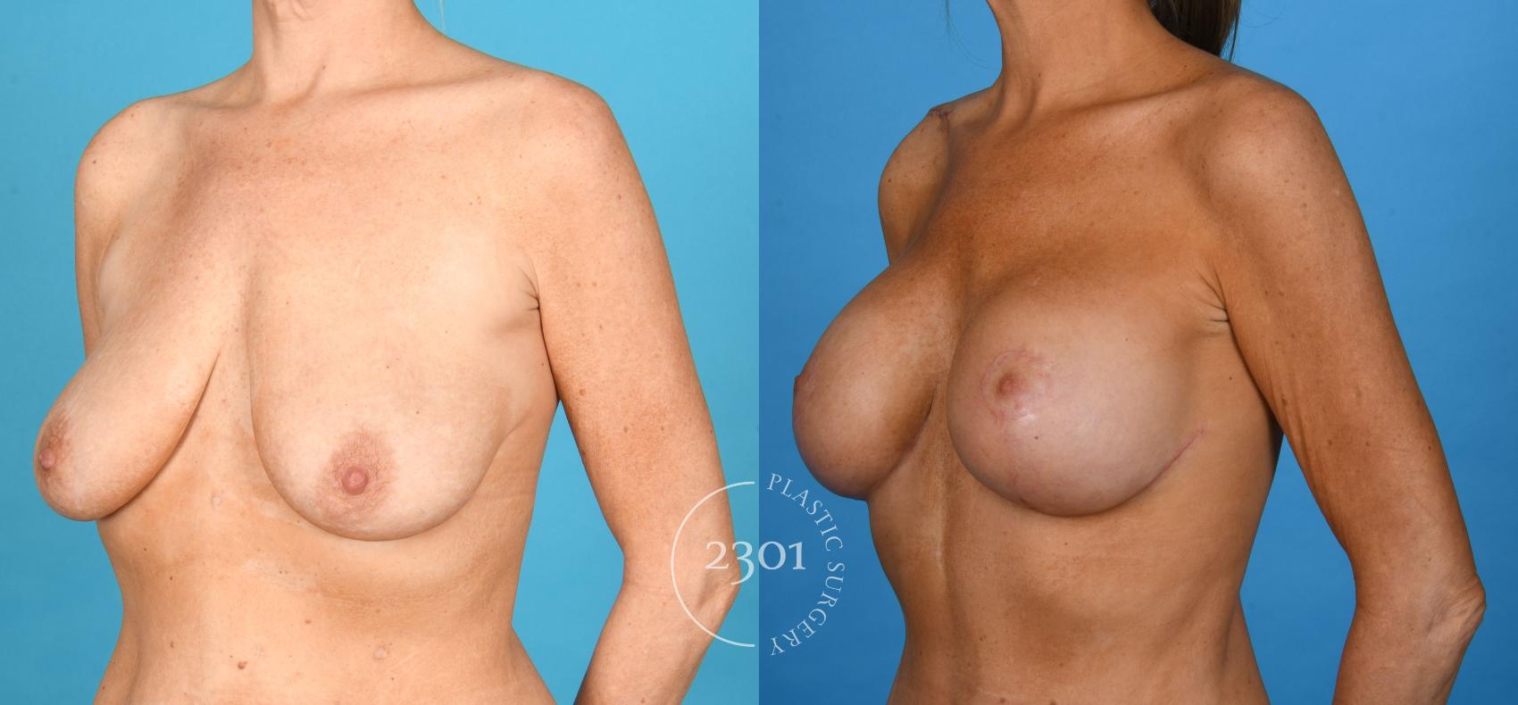 Before & After Silicone Implants Case 747 Left Oblique View in Fort Worth, Plano, & Frisco, Texas