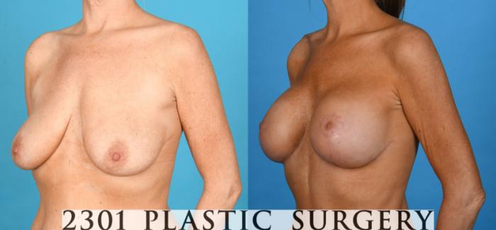 Before & After Breast Augmentation Case 747 Left Oblique View in Fort Worth, Plano, & Frisco, Texas