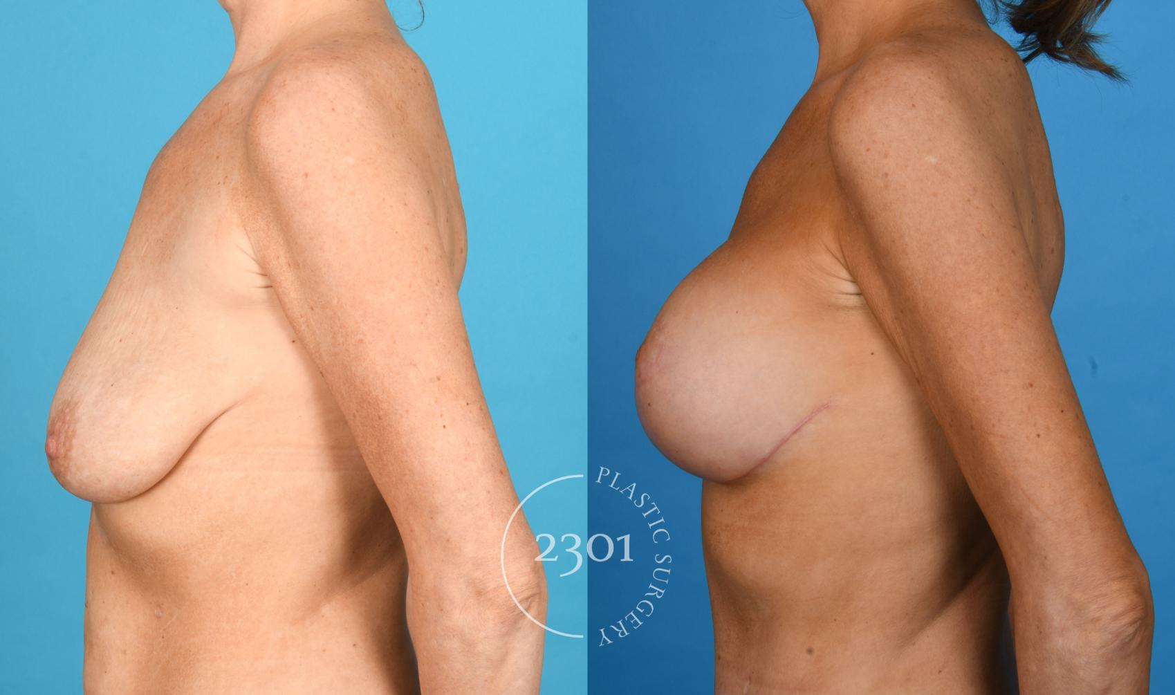 Before & After Silicone Implants Case 747 Left Side View in Fort Worth, Plano, & Frisco, Texas