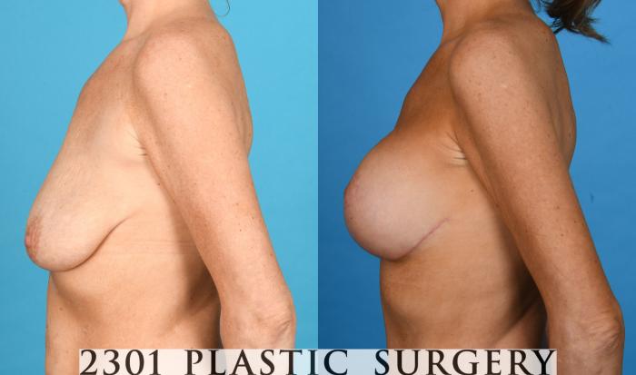Before & After Breast Augmentation Case 747 Left Side View in Fort Worth, Plano, & Frisco, Texas