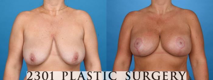 Before & After Mastopexy & Augmentation Case 760 Front View in Fort Worth & Frisco, Texas