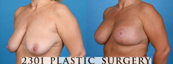 Before & After Mastopexy & Augmentation Case 760 Left Oblique View in Fort Worth, Plano, & Frisco, Texas