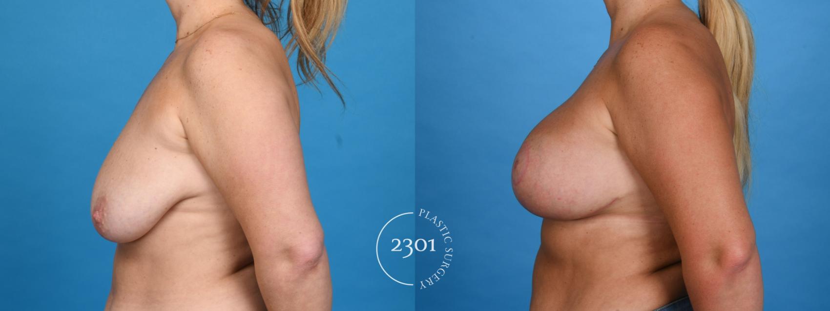 Before & After Silicone Implants Case 760 Left Side View in Fort Worth, Plano, & Frisco, Texas