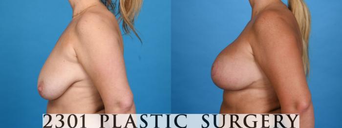 Before & After Mastopexy & Augmentation Case 760 Left Side View in Fort Worth, Plano, & Frisco, Texas