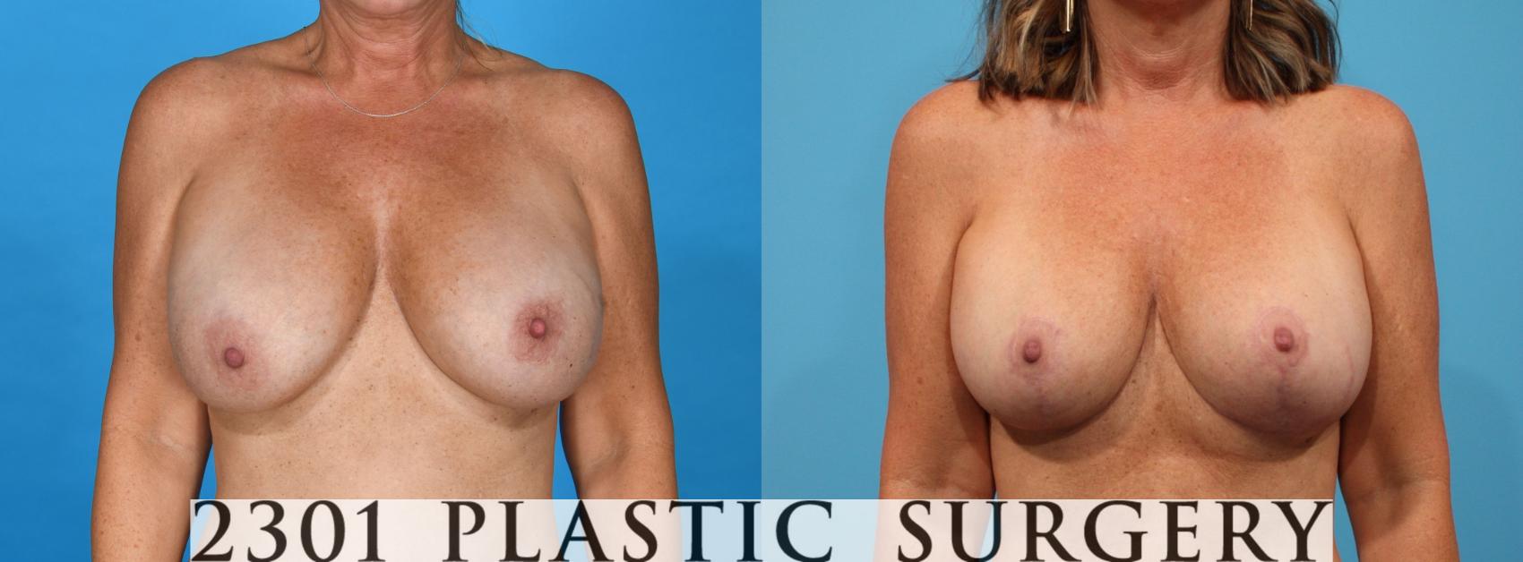 Before & After Breast Lift (Mastopexy) Case 762 Front View in Fort Worth, Plano, & Frisco, Texas