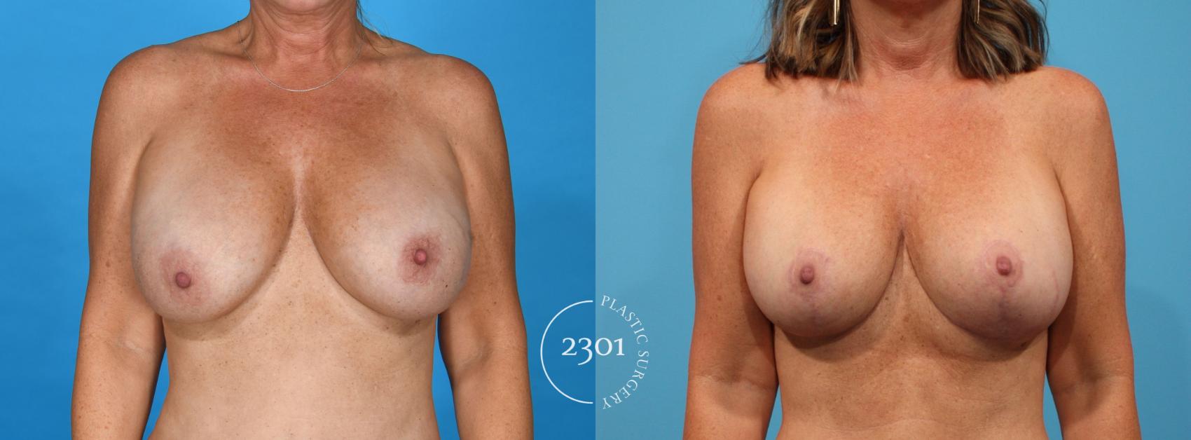 Before & After Breast Augmentation Case 762 Front View in Fort Worth, Plano, & Frisco, Texas