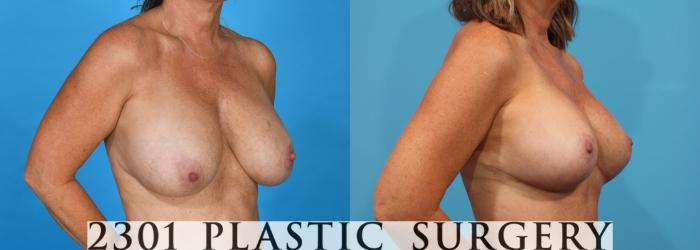 Before & After Mastopexy & Augmentation Case 762 Right Oblique View in Fort Worth, Plano, & Frisco, Texas