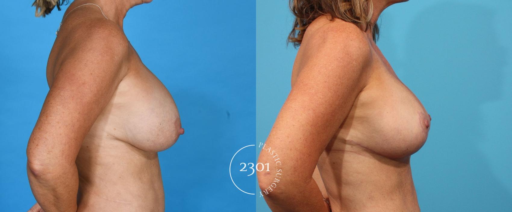 Before & After Breast Augmentation Revision Case 762 Right Side View in Fort Worth, Plano, & Frisco, Texas
