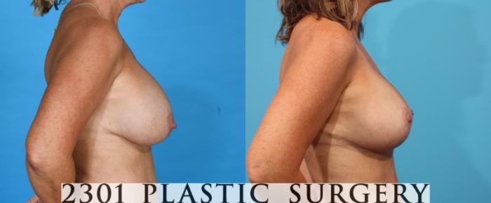 Before & After Breast Augmentation Revision Case 762 Right Side View in Fort Worth, Plano, & Frisco, Texas