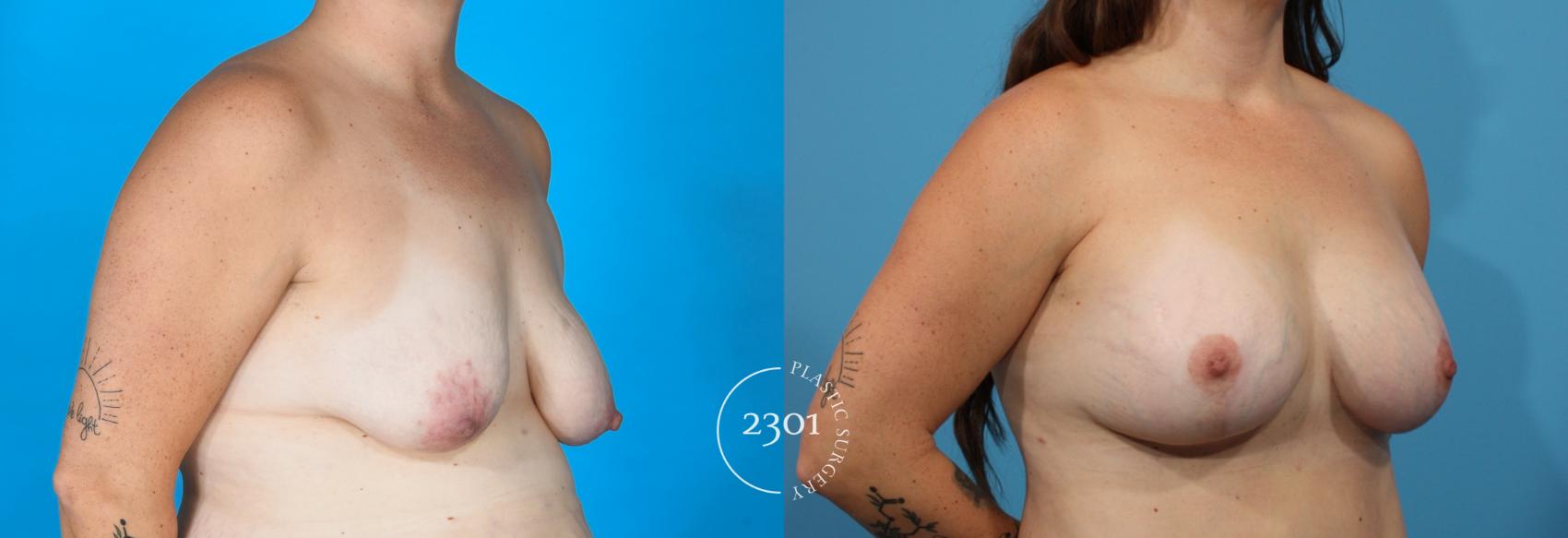 Before & After Breast Lift (Mastopexy) Case 781 Right Oblique View in Fort Worth, Plano, & Frisco, Texas