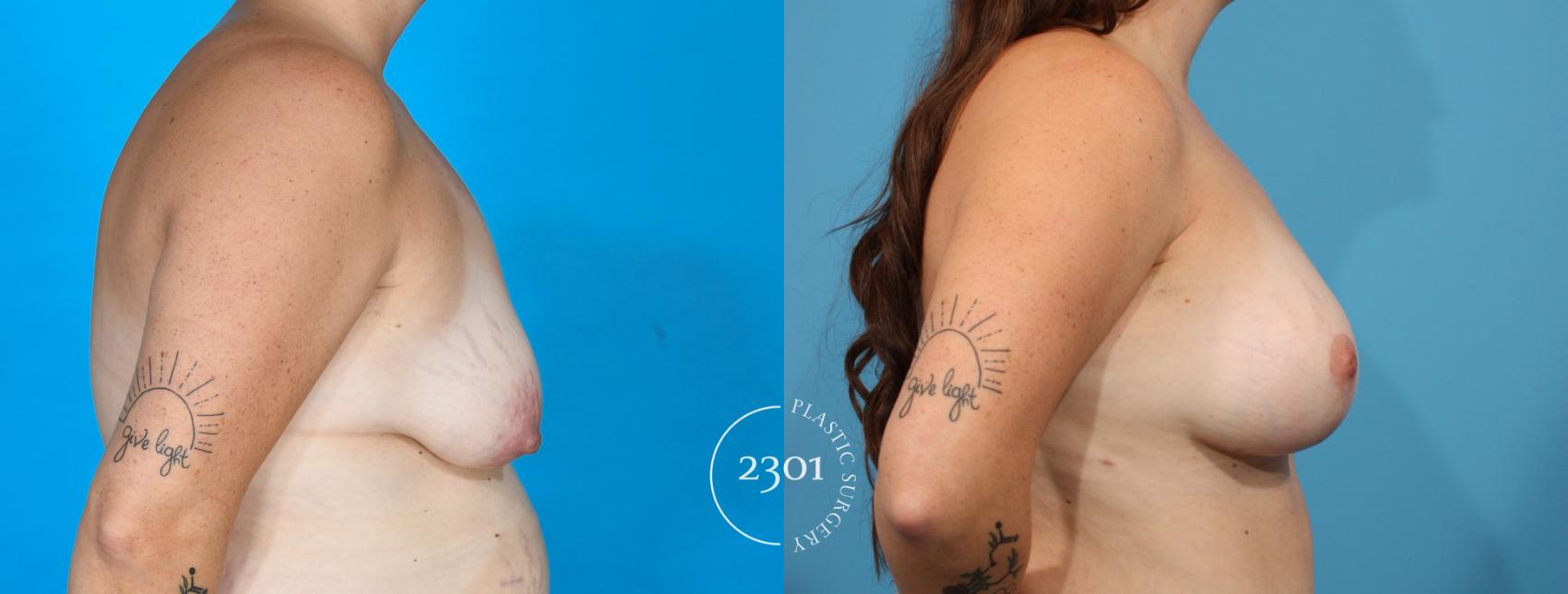Before & After Mastopexy & Augmentation Case 781 Right Side View in Fort Worth, Plano, & Frisco, Texas