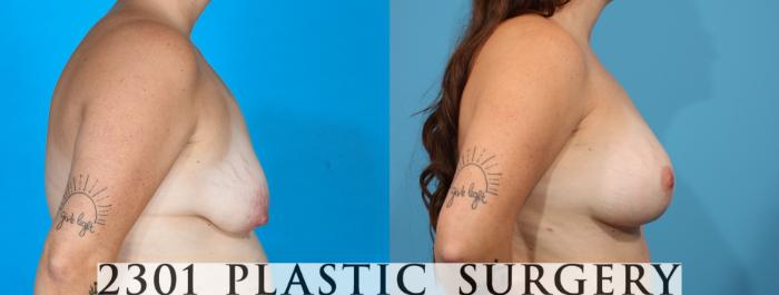Before & After Silicone Implants Case 781 Right Side View in Fort Worth, Plano, & Frisco, Texas