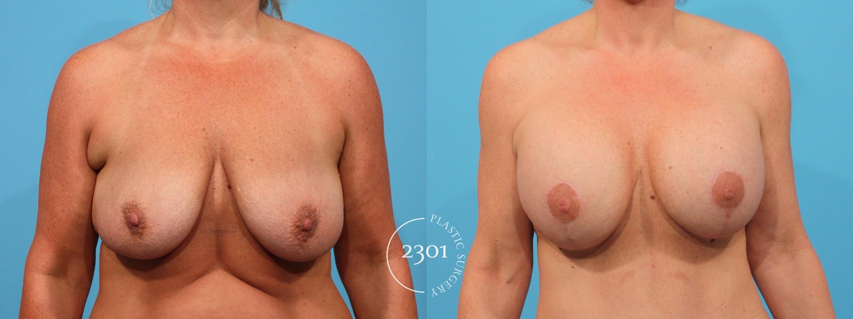 Before & After Mastopexy & Augmentation Case 782 Front View in Fort Worth, Plano, & Frisco, Texas