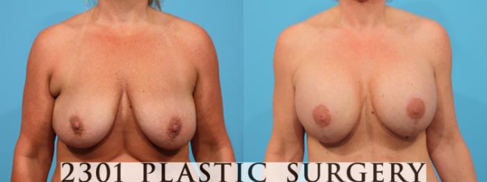 Before & After Mastopexy & Augmentation Case 782 Front View in Fort Worth, Plano, & Frisco, Texas