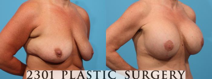 Before & After Silicone Implants Case 782 Right Oblique View in Fort Worth, Plano, & Frisco, Texas