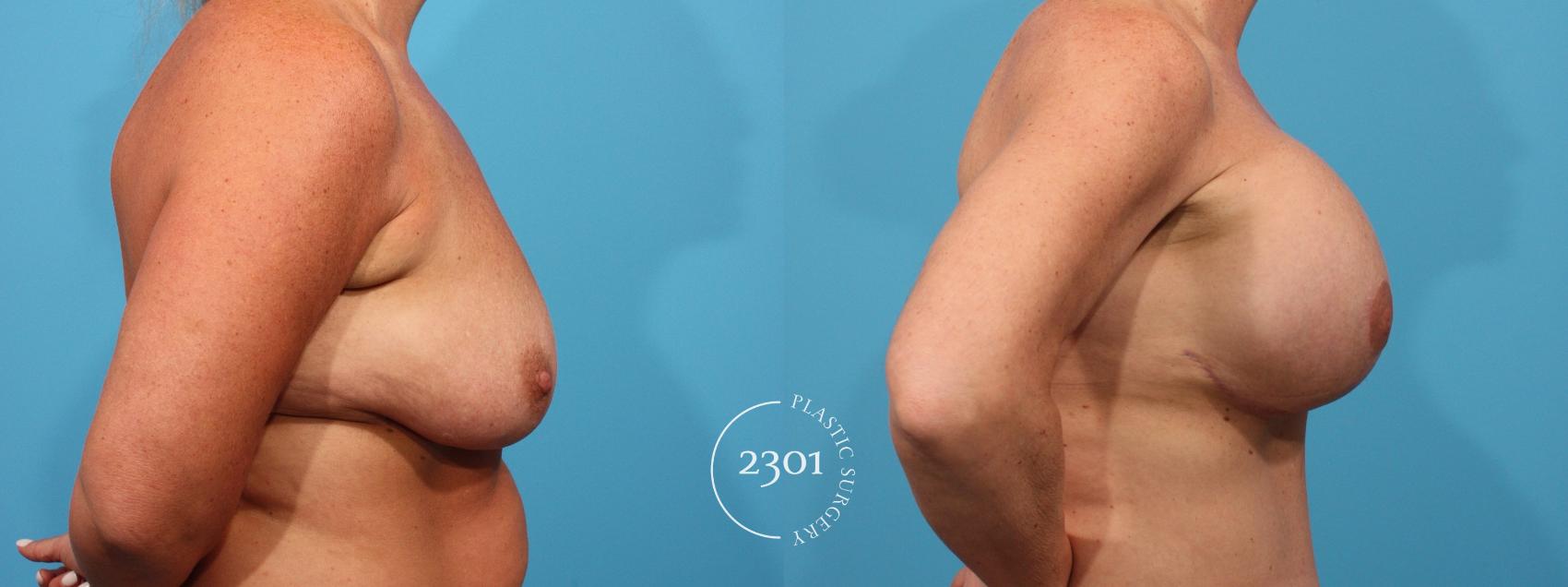 Before & After Mastopexy & Augmentation Case 782 Right Side View in Fort Worth, Plano, & Frisco, Texas