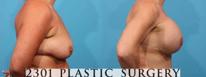 Before & After Mastopexy & Augmentation Case 782 Right Side View in Fort Worth, Plano, & Frisco, Texas
