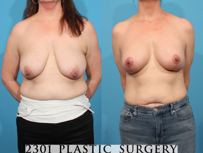 Before & After Mastopexy & Augmentation Case 793 Front View in Fort Worth, Plano, & Frisco, Texas