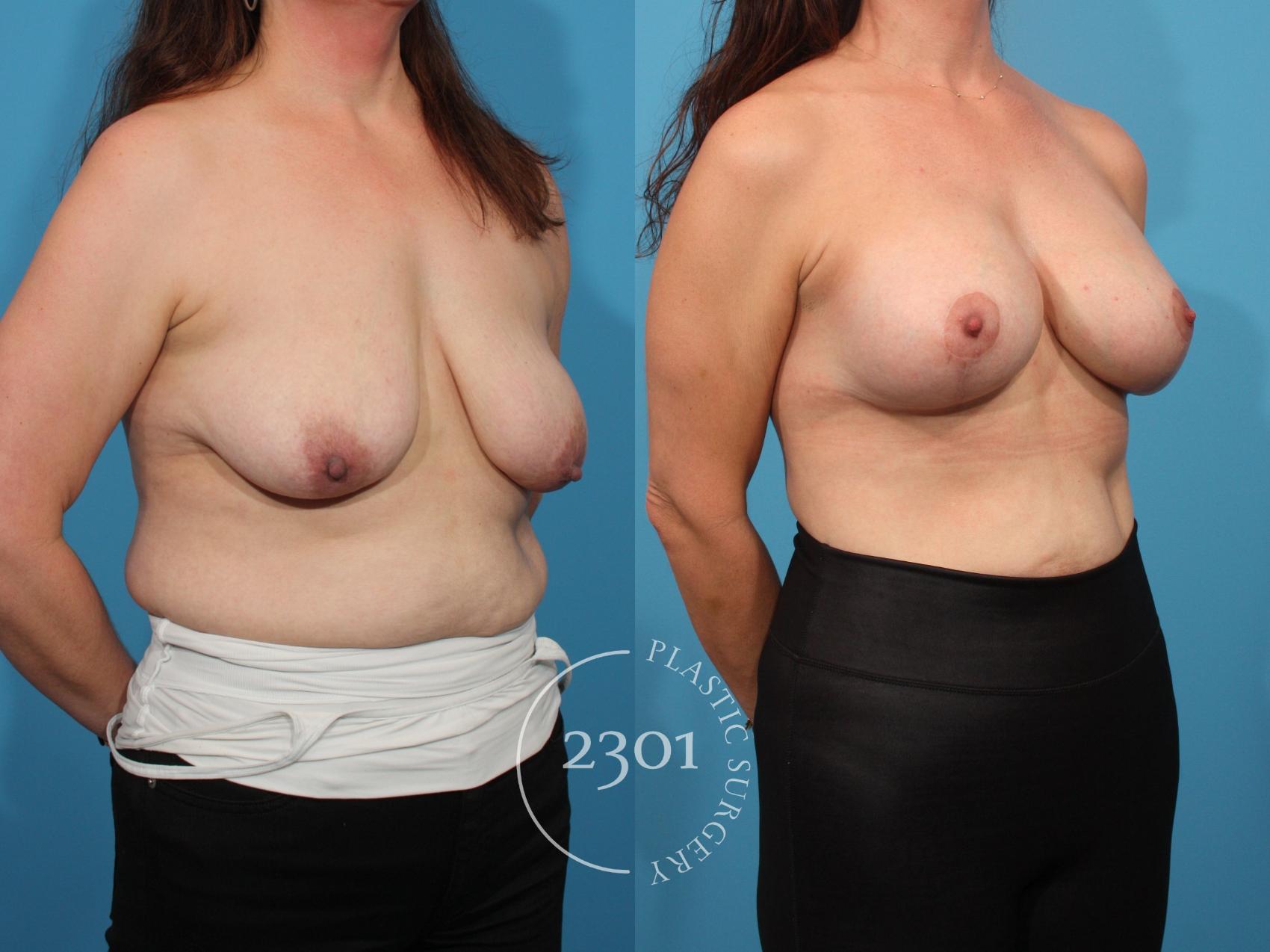 Before & After Breast Lift (Mastopexy) Case 793 Right Oblique View in Fort Worth, Plano, & Frisco, Texas