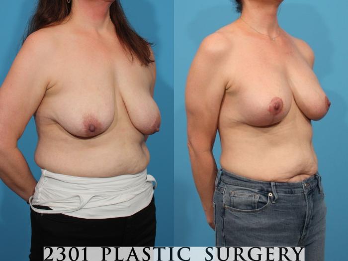 Before & After Mastopexy & Augmentation Case 793 Right Oblique View in Fort Worth, Plano, & Frisco, Texas