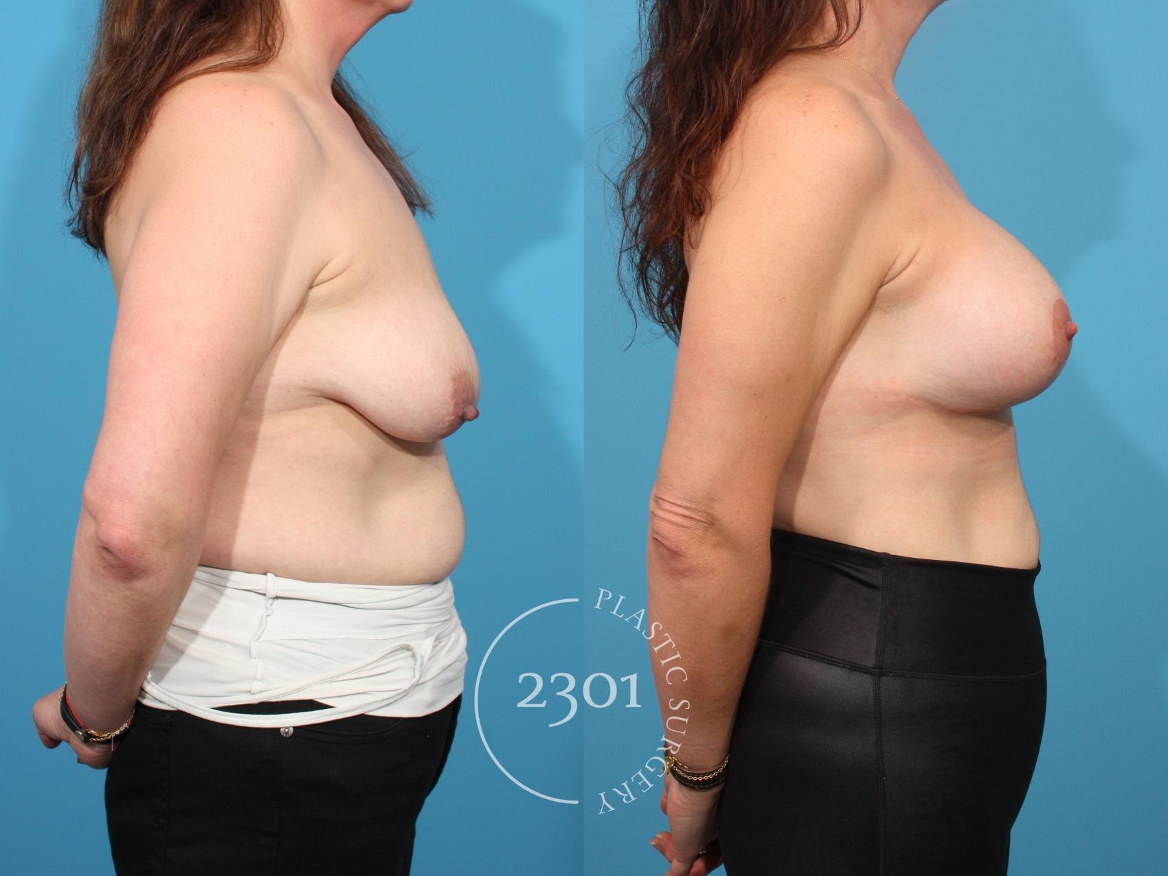 Before & After Mastopexy & Augmentation Case 793 Right Side View in Fort Worth, Plano, & Frisco, Texas