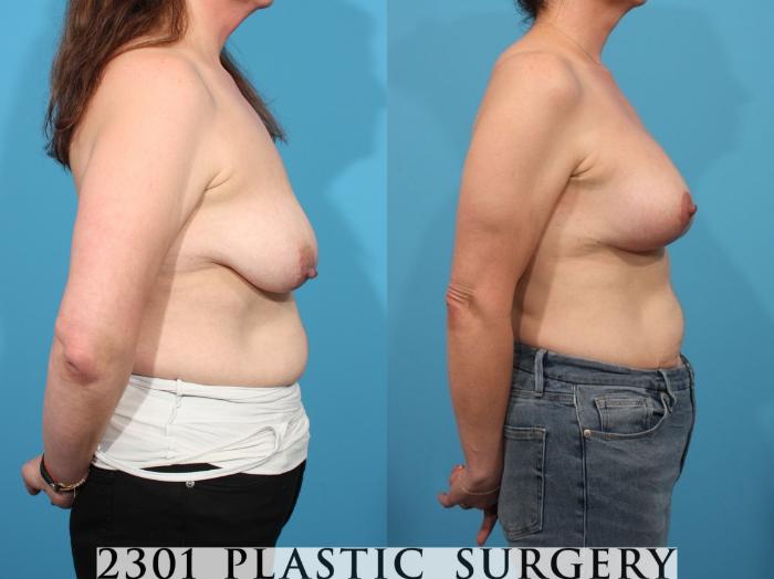 Before & After Mastopexy & Augmentation Case 793 Right Side View in Fort Worth, Plano, & Frisco, Texas